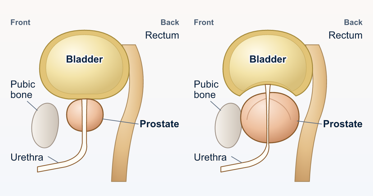 Side-view drawings of a typical prostate, with the urethra passing through freely, and an enlarged prostate that squeezes the urethra and pushes up into the bladder.
