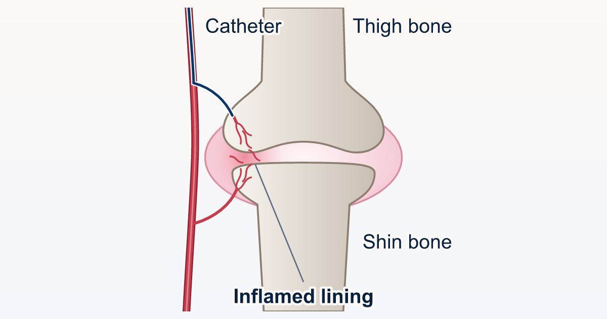Drawing of the knee seen from the front, with a small catheter reaching an artery that feeds the inflamed joint lining: step 1 of genicular artery embolization (GAE).