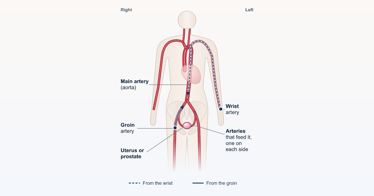 Drawing of the body seen from the front, showing a small catheter traveling from the wrist or the groin through the arteries to the pelvis.