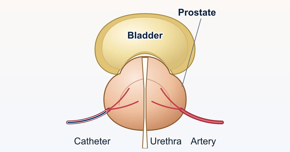 Drawing of the pelvis seen from the front, with a small catheter reaching an artery that feeds the enlarged prostate: step 1 of prostate artery embolization (PAE).