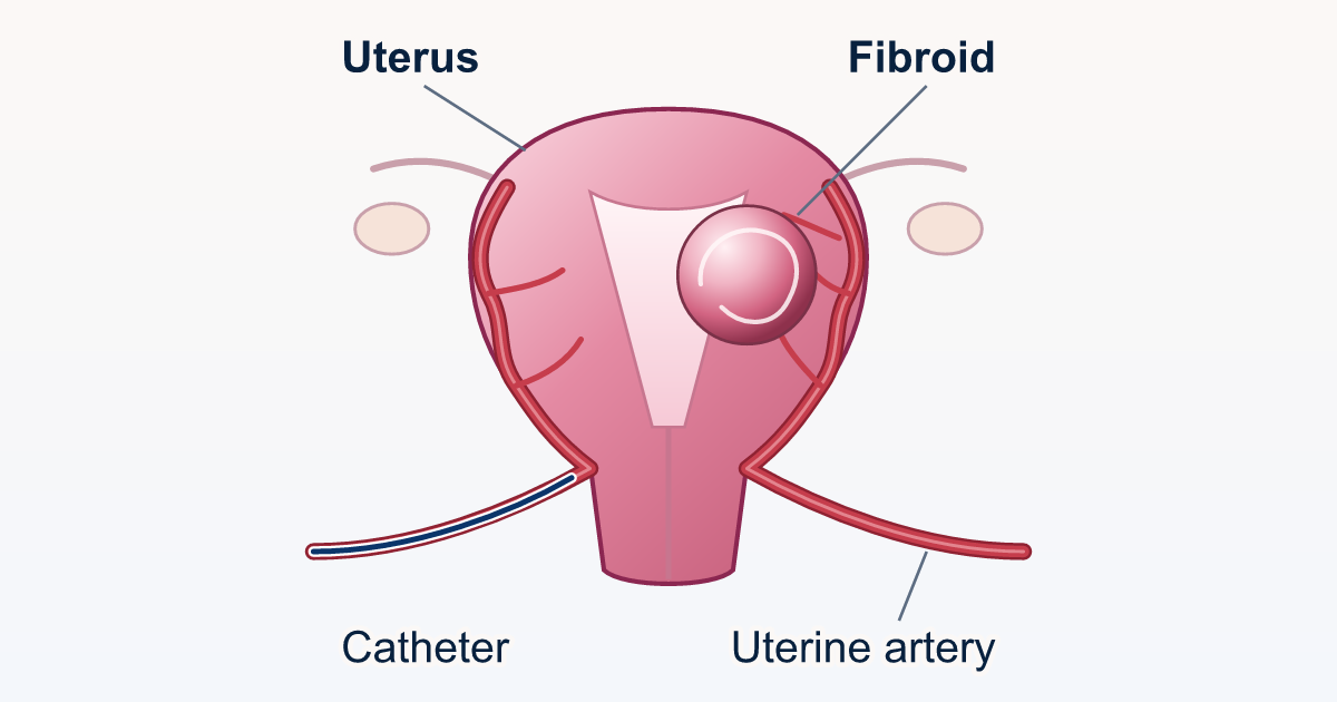 Drawing of the uterus seen from the front, with a small catheter reaching the uterine artery that feeds a fibroid: step 1 of uterine fibroid embolization (UFE).